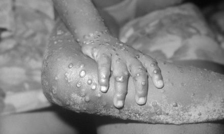 Health: What You Need to Know About the Monkeypox Virus