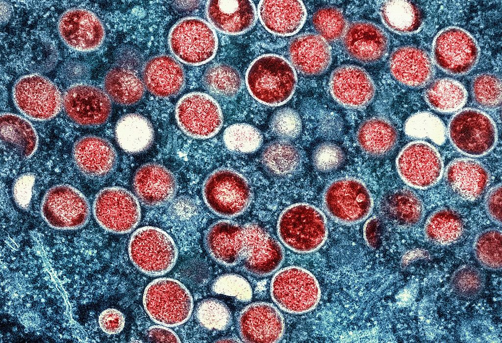 Health: In a First, Man Tests Positive for Monkeypox, HIV, and COVID-19 at the Same Time